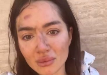 
Упала со склона, убегая от извращенца: в Одессе девушку пытался изнасиловать незнакомец
